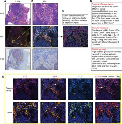 Evaluation of multiple immune cells and patient outcomes in esophageal squamous cell carcinoma
